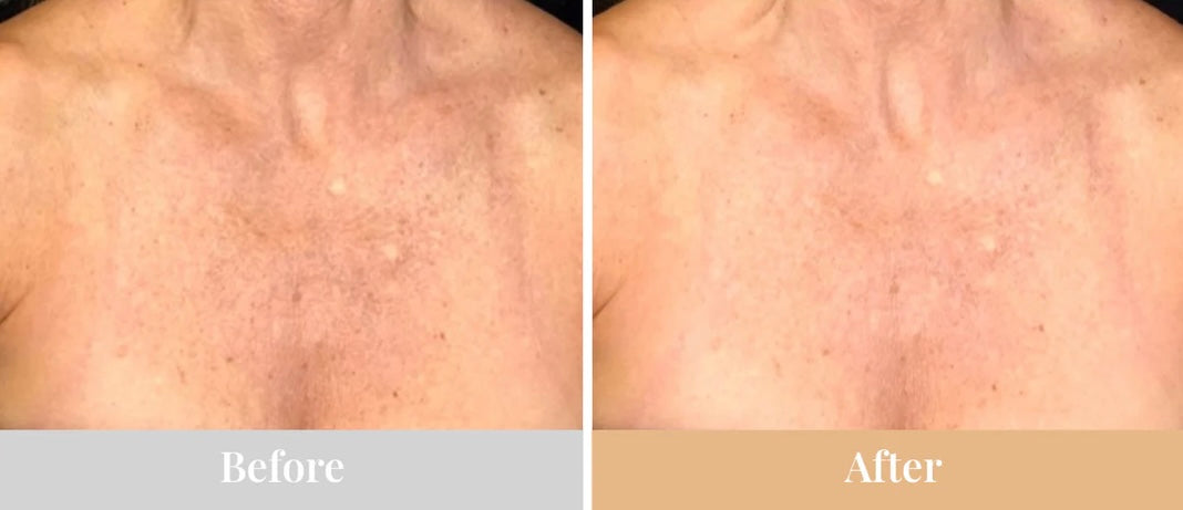 Omnilux Contour Neck & Decollete