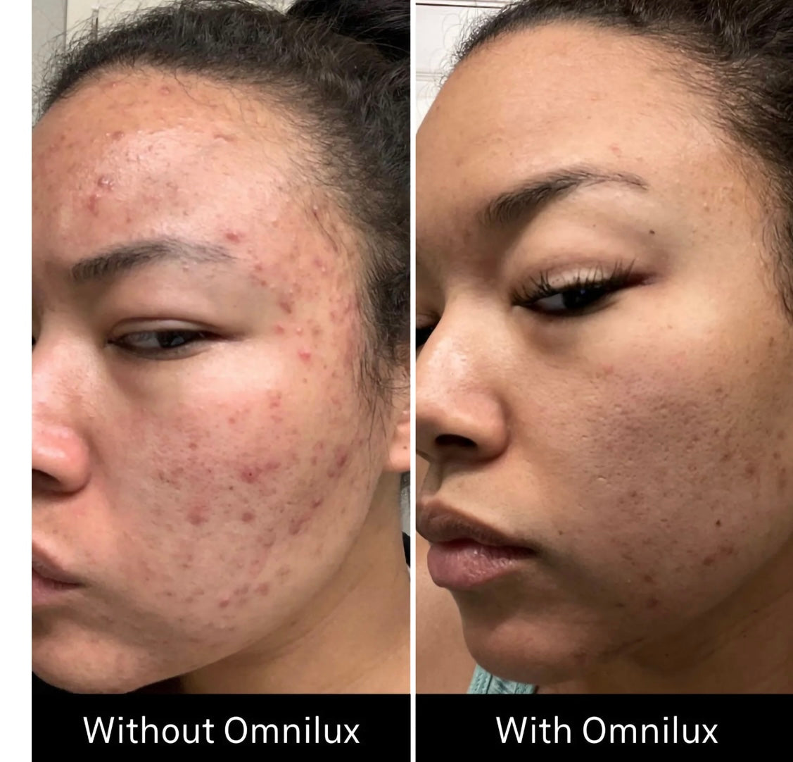 Omnilux Clear