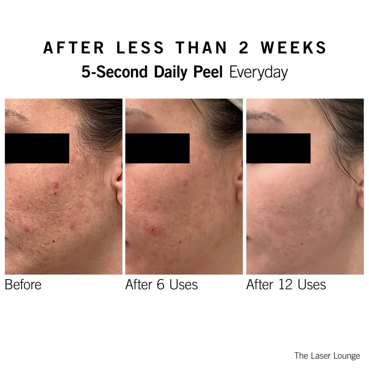 5-Second Daily Peel