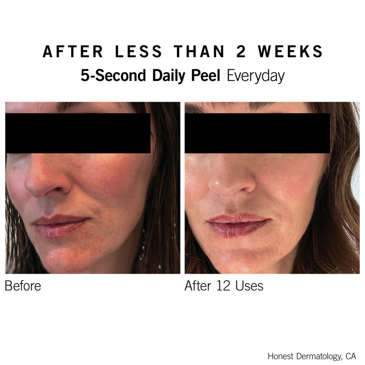 5-Second Daily Peel