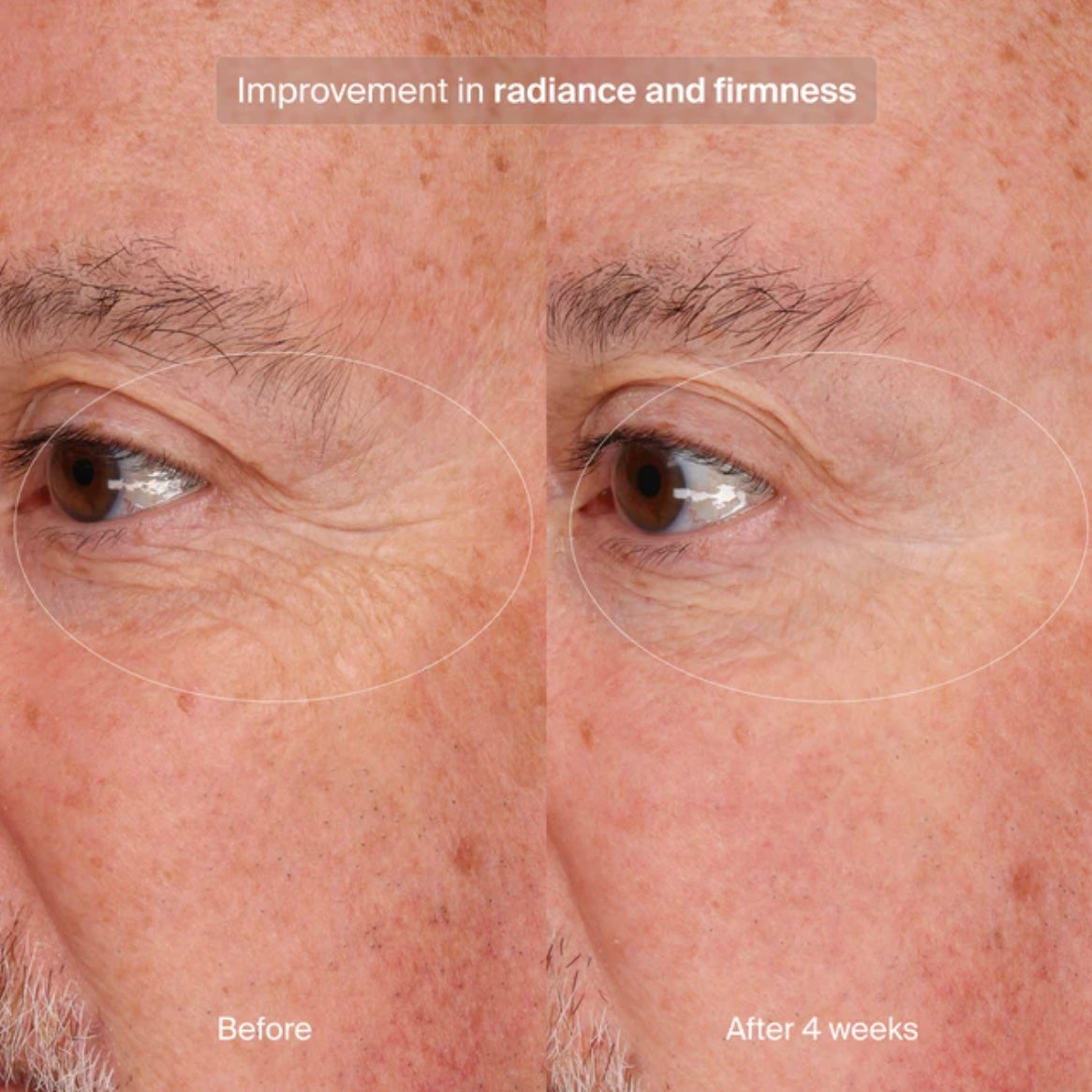 Precision Eye Lift