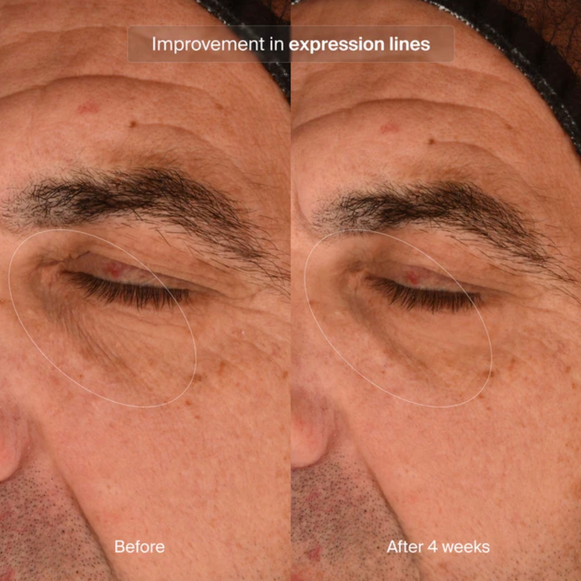 Precision Eye Lift