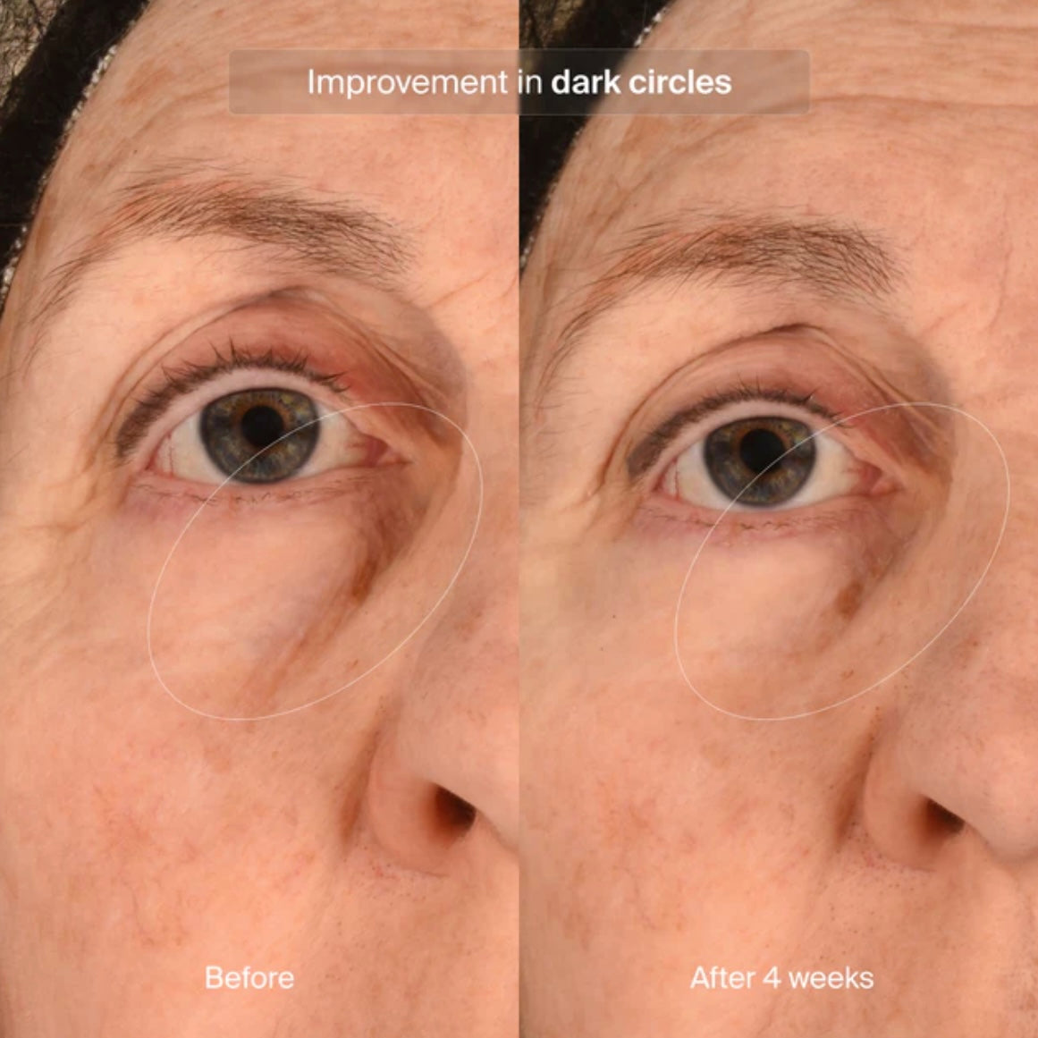 Precision Eye Lift