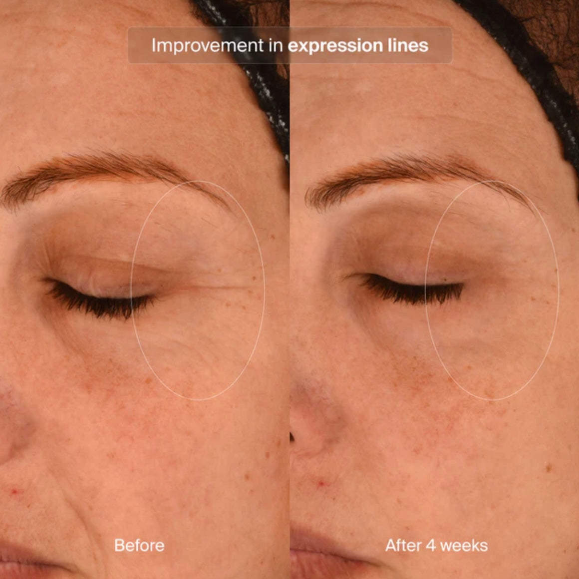 Precision Eye Lift